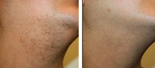 Лазерная эпиляция бороды у мужчин